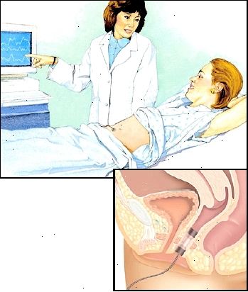 Κατά τη διάρκεια της βιοανάδρασης, οι αισθητήρες στέλνουν σήματα από τους μύες του πυελικού εδάφους σας σε μια οθόνη υπολογιστή. Κατά τη διάρκεια της βιοανάδρασης, οι αισθητήρες στέλνουν σήματα από τους μύες του πυελικού εδάφους σας σε μια οθόνη υπολογιστή.