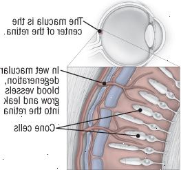 Εκφύλιση της ωχράς κηλίδας Εκφύλιση της ωχράς κηλίδας