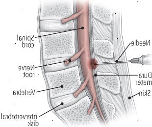 Μια ματιά στις δύο θεραπείες ένεση: επισκληρίδιο ένεση στεροειδών Μια ματιά στις δύο θεραπείες ένεση: επισκληρίδιο ένεση στεροειδών