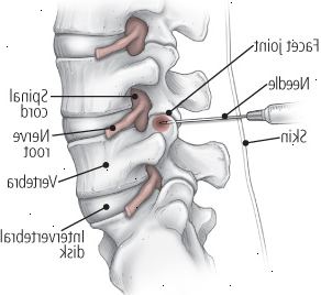 Μια ματιά στις δύο θεραπείες ένεση: όψη κοινή ένεση Μια ματιά στις δύο θεραπείες ένεση: όψη κοινή ένεση