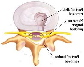 Κάτοψη των σπονδύλων και του δίσκου. Μέρος του δίσκου αφαιρείται από την πίσω πλευρά, και μέρος του ελάσματος απομακρύνονται. Νεύρων δεν είναι πλέον τσιμπημένο. Κάτοψη των σπονδύλων και του δίσκου. Μέρος του δίσκου αφαιρείται από την πίσω πλευρά, και μέρος του ελάσματος απομακρύνονται. Νεύρων δεν είναι πλέον τσιμπημένο.
