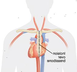 Εικόνα της τοποθέτησης μιας εντομής στο στήθος Εικόνα της τοποθέτησης μιας εντομής στο στήθος