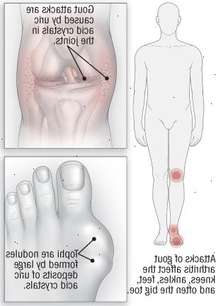 Αρθρίτιδα Αρθρίτιδα