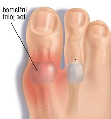 Αρθρίτιδα Αρθρίτιδα