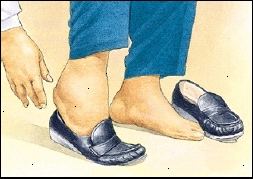 Πρησμένους αστραγάλους