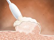 Φάρμακα μπορεί να εφαρμοστεί για να σπάσει κονδυλώματα χώρια. Φάρμακα μπορεί να εφαρμοστεί για να σπάσει κονδυλώματα χώρια.