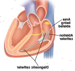 Οι καθετήρες θα καθοδηγείται στην καρδιά Οι καθετήρες θα καθοδηγείται στην καρδιά