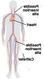 Θέσεις εισαγωγής μπορεί να είναι στη βουβωνική χώρα ή στο λαιμό Θέσεις εισαγωγής μπορεί να είναι στη βουβωνική χώρα ή στο λαιμό