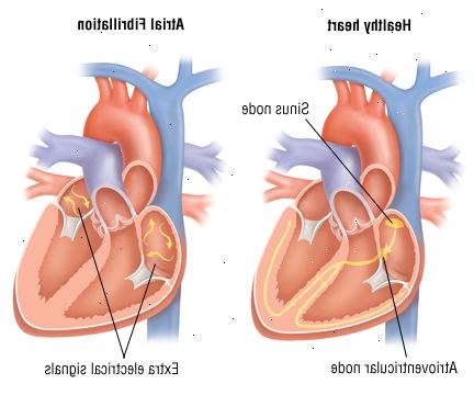 Η κολπική μαρμαρυγή 1 Η κολπική μαρμαρυγή 1