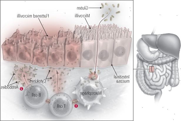 Celiace ενάντια στο σιτάρι Celiace ενάντια στο σιτάρι