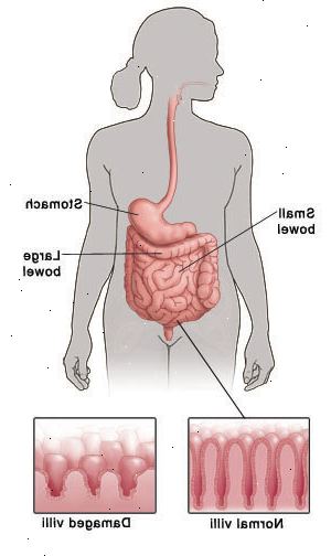 Περίγραμμα της ανθρώπινης μορφής που δείχνει πεπτικό σύστημα και επισημαίνοντας στομάχου, του λεπτού εντέρου, και το παχύ έντερο. Η λεπτομέρεια δείχνει φυσιολογική λαχνών ως σαρκώδη στελέχη στενόμακρα επένδυση του εντέρου σε σύγκριση με λίγα λόγια, κατεστραμμένα λαχνών. Περίγραμμα της ανθρώπινης μορφής που δείχνει πεπτικό σύστημα και επισημαίνοντας στομάχου, του λεπτού εντέρου, και το παχύ έντερο. Η λεπτομέρεια δείχνει φυσιολογική λαχνών ως σαρκώδη στελέχη στενόμακρα επένδυση του εντέρου σε σύγκριση με λίγα λόγια, κατεστραμμένα λαχνών.