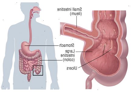Νόσος του Crohn Νόσος του Crohn