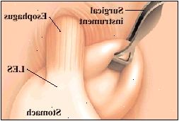 Η κορυφή του στομάχου είναι τυλιγμένο γύρω από τον οισοφάγο. Η κορυφή του στομάχου είναι τυλιγμένο γύρω από τον οισοφάγο.