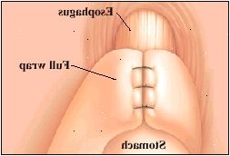 Το περιτύλιγμα είναι μόνιμα ραμμένο στη θέση του. Δύο χρησιμοποιούνται συνήθως αναδιπλώνεται είναι πλήρη και μερική. Το περιτύλιγμα είναι μόνιμα ραμμένο στη θέση του. Δύο χρησιμοποιούνται συνήθως αναδιπλώνεται είναι πλήρη και μερική.