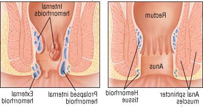 Αιμορροΐδες Αιμορροΐδες