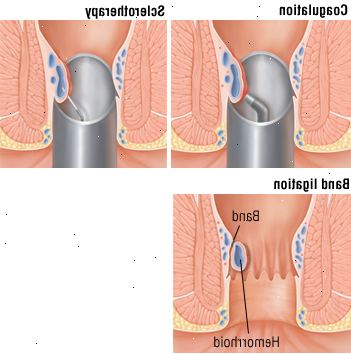 Αιμορροΐδες Αιμορροΐδες