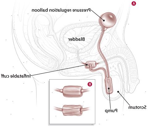 Τεχνητού σφιγκτήρα