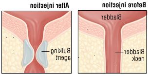 Κύστη Κύστη