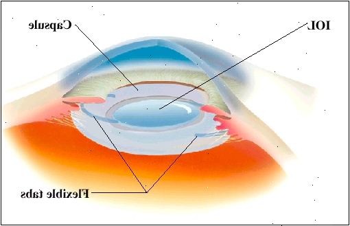 Ο IOL ξεδιπλώνεται καθώς εισάγεται στη φυσική κάψα του ματιού. Ευέλικτες καρτέλες κρατήστε πατημένο το IOL στη θέση του. Ο IOL ξεδιπλώνεται καθώς εισάγεται στη φυσική κάψα του ματιού. Ευέλικτες καρτέλες κρατήστε πατημένο το IOL στη θέση του.