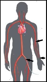 Θέσεις εισαγωγής μπορεί να είναι στη βουβωνική χώρα ή στο βραχίονα. Θέσεις εισαγωγής μπορεί να είναι στη βουβωνική χώρα ή στο βραχίονα.