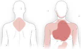 Καρδιακή προσβολή του πόνου Καρδιακή προσβολή του πόνου