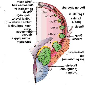 Σταδιοποίηση του καρκίνου της ουροδόχου κύστης Σταδιοποίηση του καρκίνου της ουροδόχου κύστης