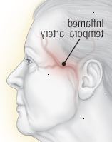 Όταν πονάει στην αφή: κροταφική αρτηρίτιδα Όταν πονάει στην αφή: κροταφική αρτηρίτιδα