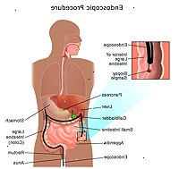 Απεικόνιση που καταδεικνύει μια κολονοσκόπηση Απεικόνιση που καταδεικνύει μια κολονοσκόπηση