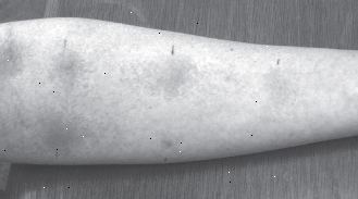 Μια θετική δοκιμασίες νυγμού Μια θετική δοκιμασίες νυγμού