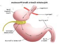 Εικονογράφηση της περιοριστικής χειρουργική επέμβαση για την απώλεια βάρους Εικονογράφηση της περιοριστικής χειρουργική επέμβαση για την απώλεια βάρους