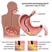 Εικονογράφηση ενός esophagogastroduodenoscopy διαδικασίας Εικονογράφηση ενός esophagogastroduodenoscopy διαδικασίας