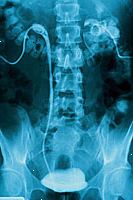 Εικόνα μιας ενδοφλέβιας ταινία pyelogram Εικόνα μιας ενδοφλέβιας ταινία pyelogram