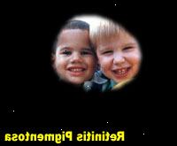 Φωτογραφία Προσομοίωση: μελαγχρωστική αμφιβληστροειδοπάθεια