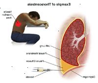 Εικονογράφηση της διαδικασίας θώρακα Εικονογράφηση της διαδικασίας θώρακα