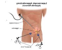 Εικονογράφηση λαπαροσκοπική σκωληκοειδεκτομή Εικονογράφηση λαπαροσκοπική σκωληκοειδεκτομή