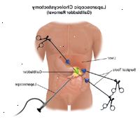 Εικονογράφηση λαπαροσκοπική χολοκυστεκτομή Εικονογράφηση λαπαροσκοπική χολοκυστεκτομή