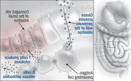 Κοιλιοκάκη: μια αυτοάνοση αντίδραση Κοιλιοκάκη: μια αυτοάνοση αντίδραση