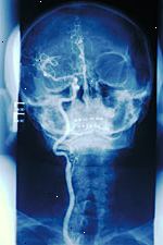 Εικόνα ενός αγγειογραφία της καρωτίδας