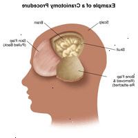 Εικονογράφηση ένα παράδειγμα μιας διαδικασίας κρανιοτομή Εικονογράφηση ένα παράδειγμα μιας διαδικασίας κρανιοτομή