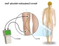 Μια απεικόνιση μιας δοκιμής ταχύτητα μεταβίβασης των νεύρων Μια απεικόνιση μιας δοκιμής ταχύτητα μεταβίβασης των νεύρων