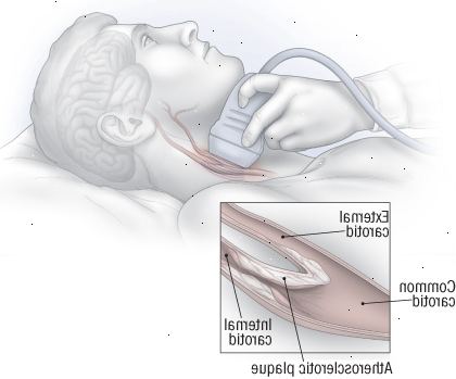 Υπερηχογράφημα των καρωτίδων αρτηριών Υπερηχογράφημα των καρωτίδων αρτηριών
