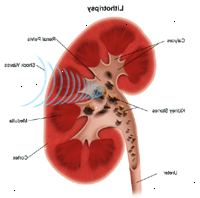 Εικονογράφηση της λιθοτριψίας Εικονογράφηση της λιθοτριψίας