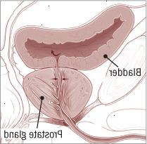 Ακράτεια από υπερπλήρωση