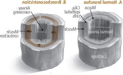 Βρογχοσυστολή Βρογχοσυστολή