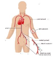 Εικονογράφηση αποδεικνύοντας sites καθετήρα Εικονογράφηση αποδεικνύοντας sites καθετήρα
