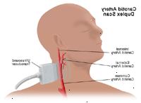 Εικονογράφηση ενός υπερηχογράφημα καρωτιδικής αρτηρίας Εικονογράφηση ενός υπερηχογράφημα καρωτιδικής αρτηρίας