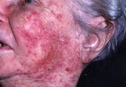 Rosacea Rosacea