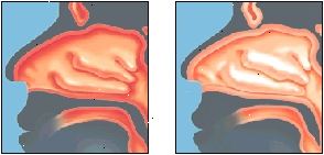Αποσυμφορητικά συρρικνώνονται τον πρησμένο ρινική ιστούς. Αποσυμφορητικά συρρικνώνονται τον πρησμένο ρινική ιστούς.