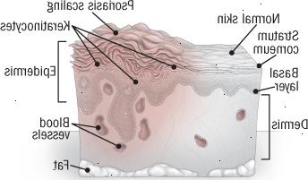 Ανατομία της ψωρίασης Ανατομία της ψωρίασης