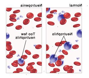 Ουδετεροπενία Ουδετεροπενία